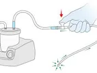 Sterile Suction Catheter Thumb Control